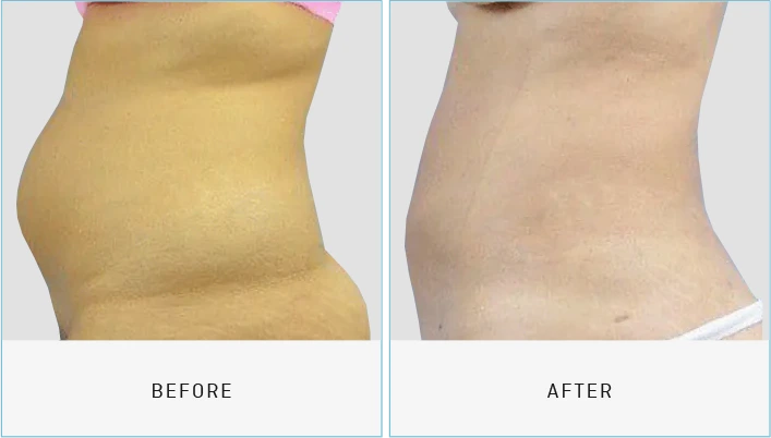 Liposuction Before & After Banner