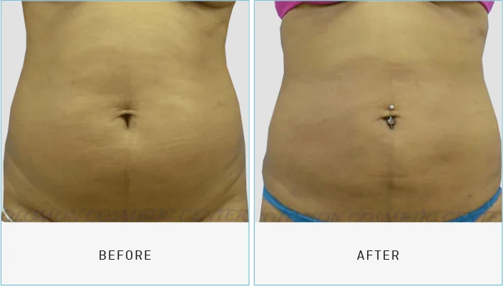 Liposuction Before & After Banner