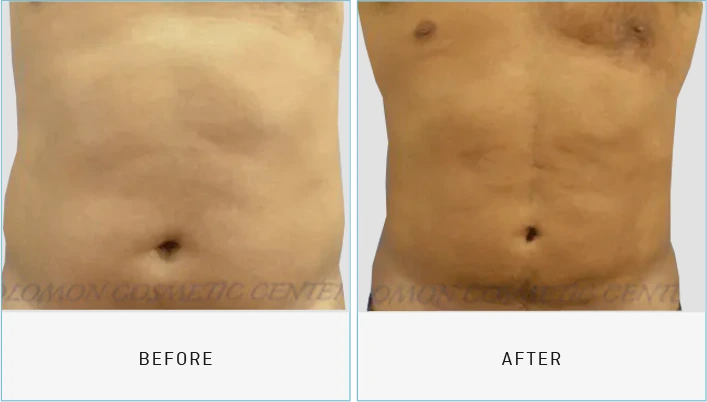 Liposuction Before & After Banner