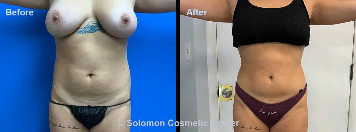 Body-Lipo-Suction
