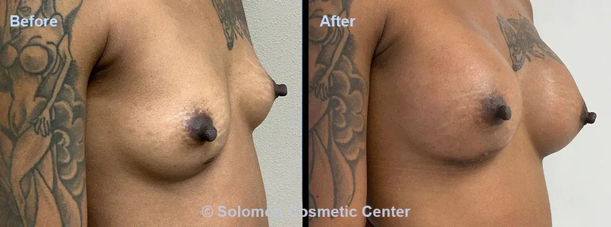 Breast-Augmentation-1