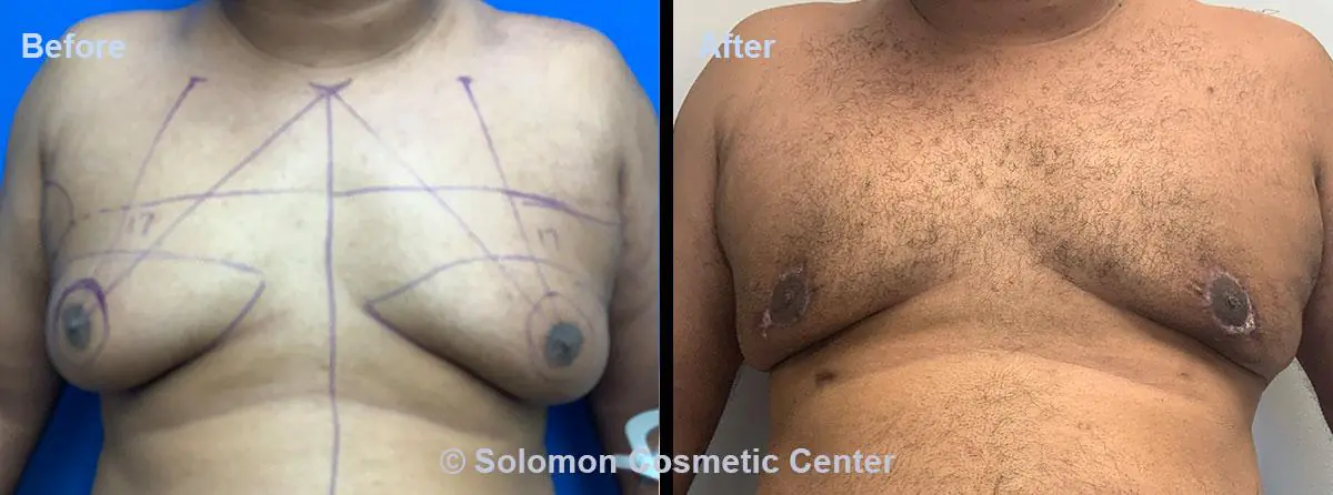 Gynecomastia-2