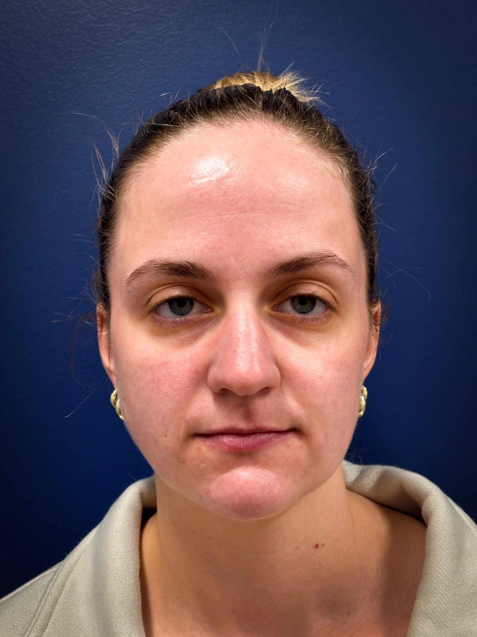 Submental-Liposuction-Case--4705 | After Submental Liposuction 1