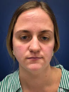 Submental-Liposuction-Case--4705 | Before Submental Liposuction 1