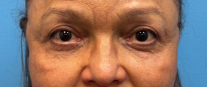 Upper-Blepharoplasty-Case--27682 | After Eyelid Surgery 1