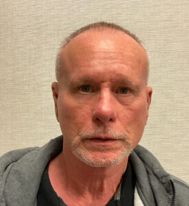 Rhinoplasty-Case--3129 | After Rhinoplasty 1