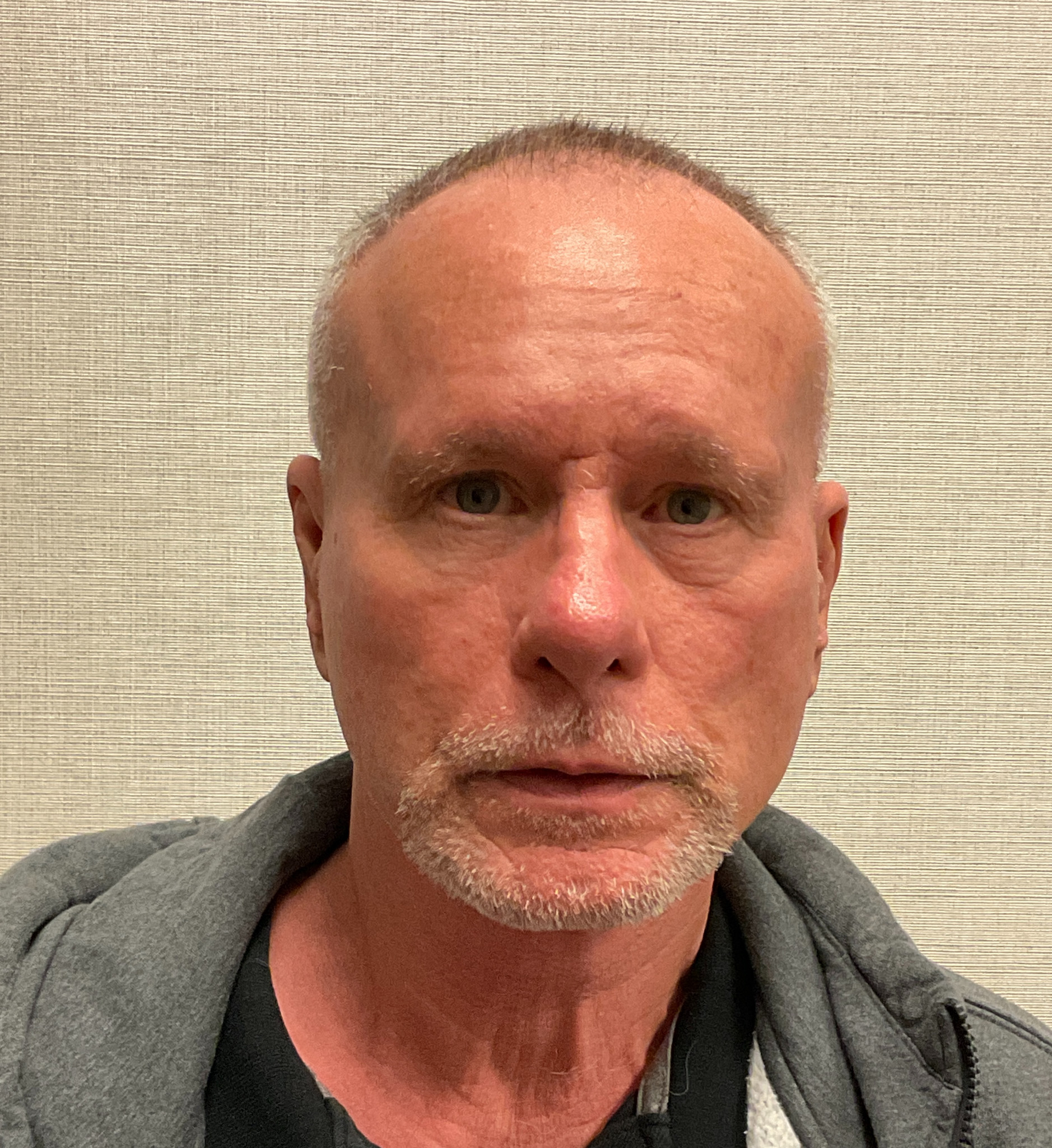 Rhinoplasty-Case--3129 | After Rhinoplasty 1