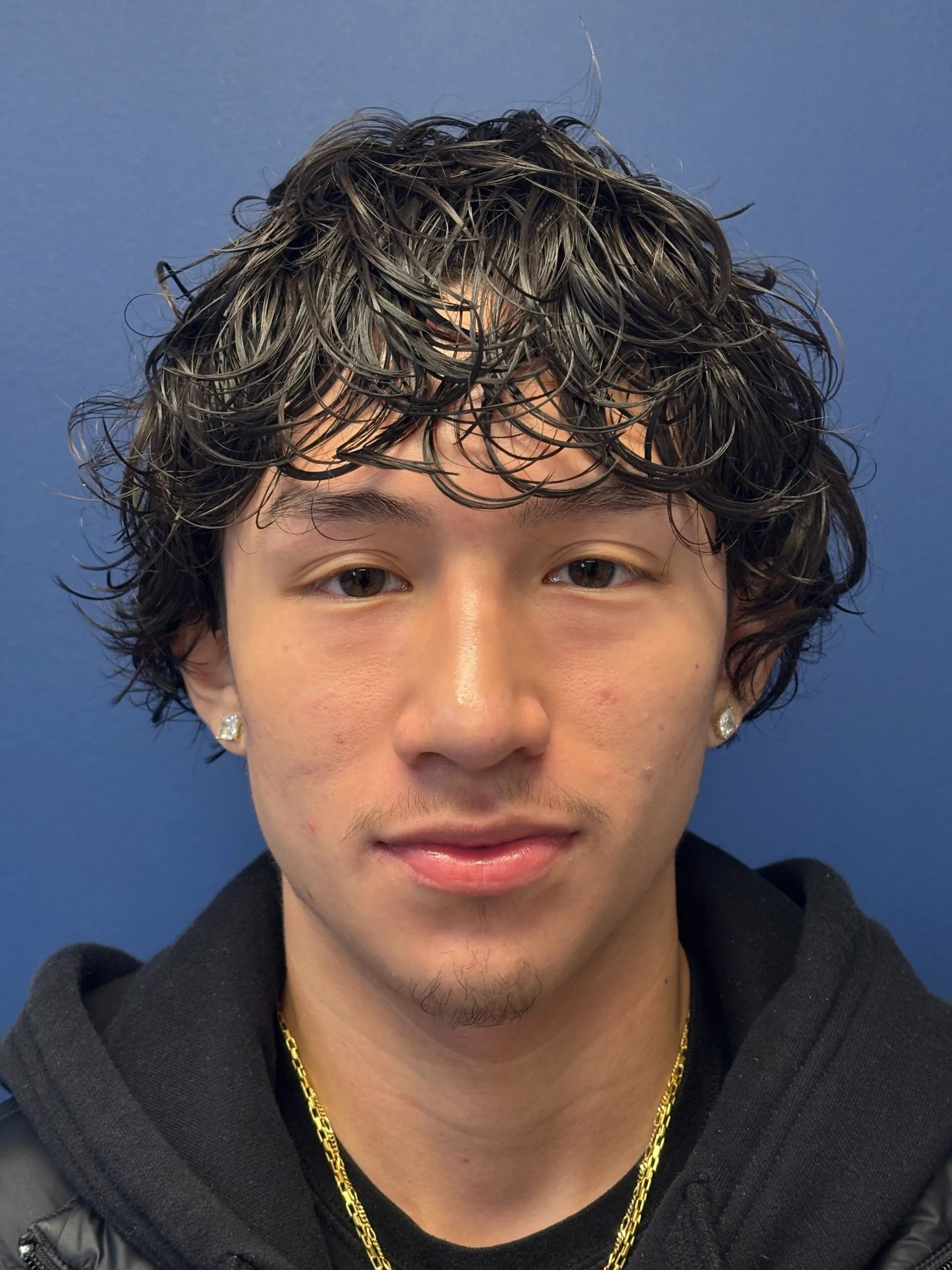 Rhinoplasty-Case--2339 | After Rhinoplasty 1