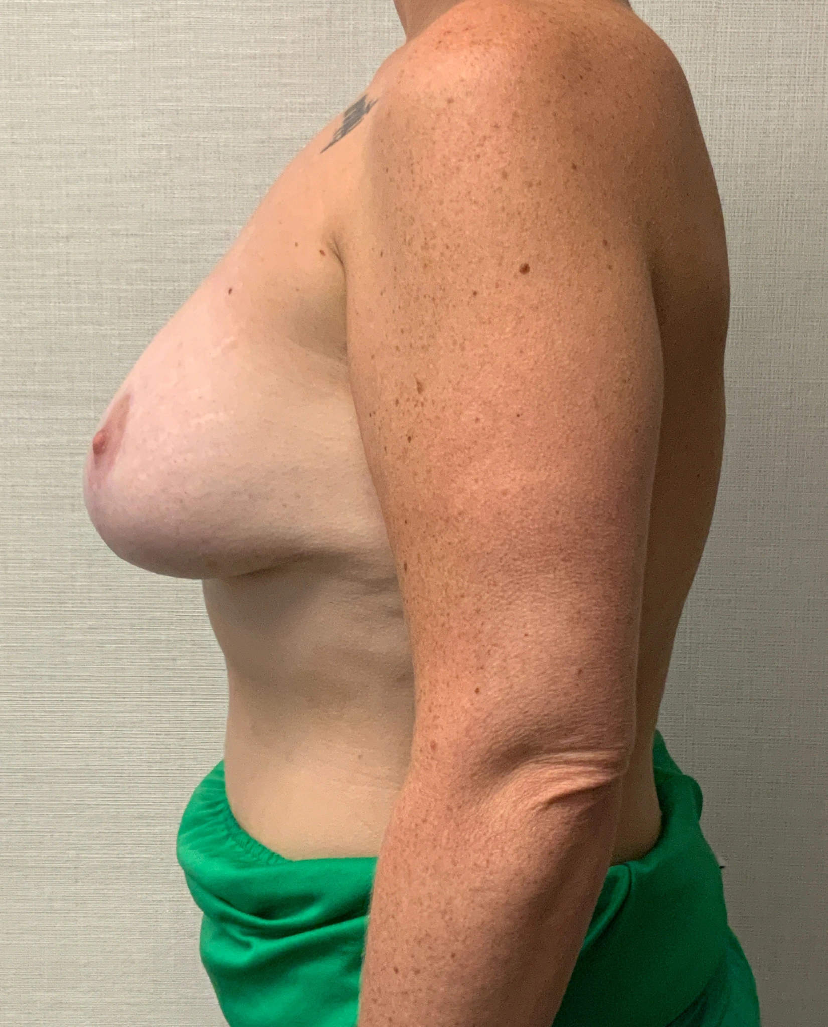 Augmentation-Mastopexy-Case--6355 | After Breast Augmentation With Lift 3