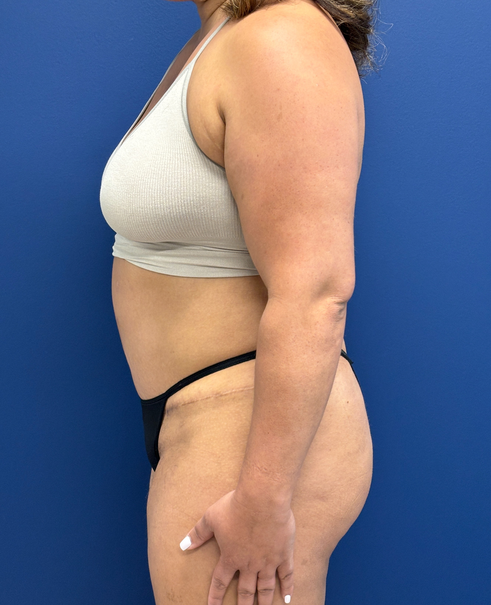 Abdominoplasty-Case--9870 | After Tummy Tuck 3