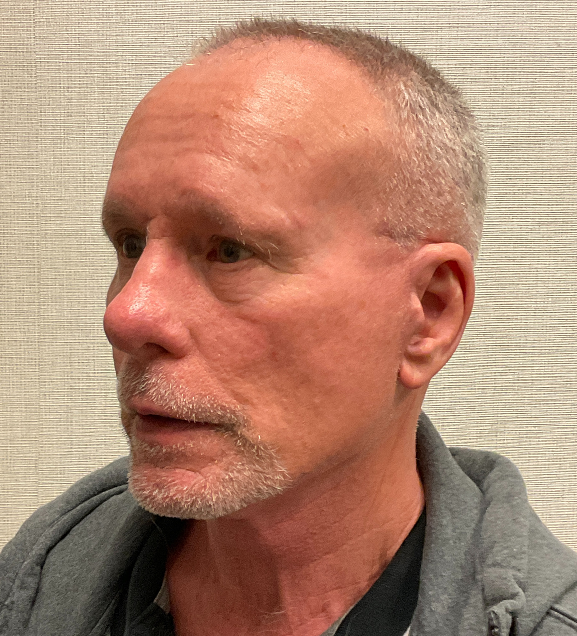 Rhinoplasty-Case--3129 | After Rhinoplasty 4