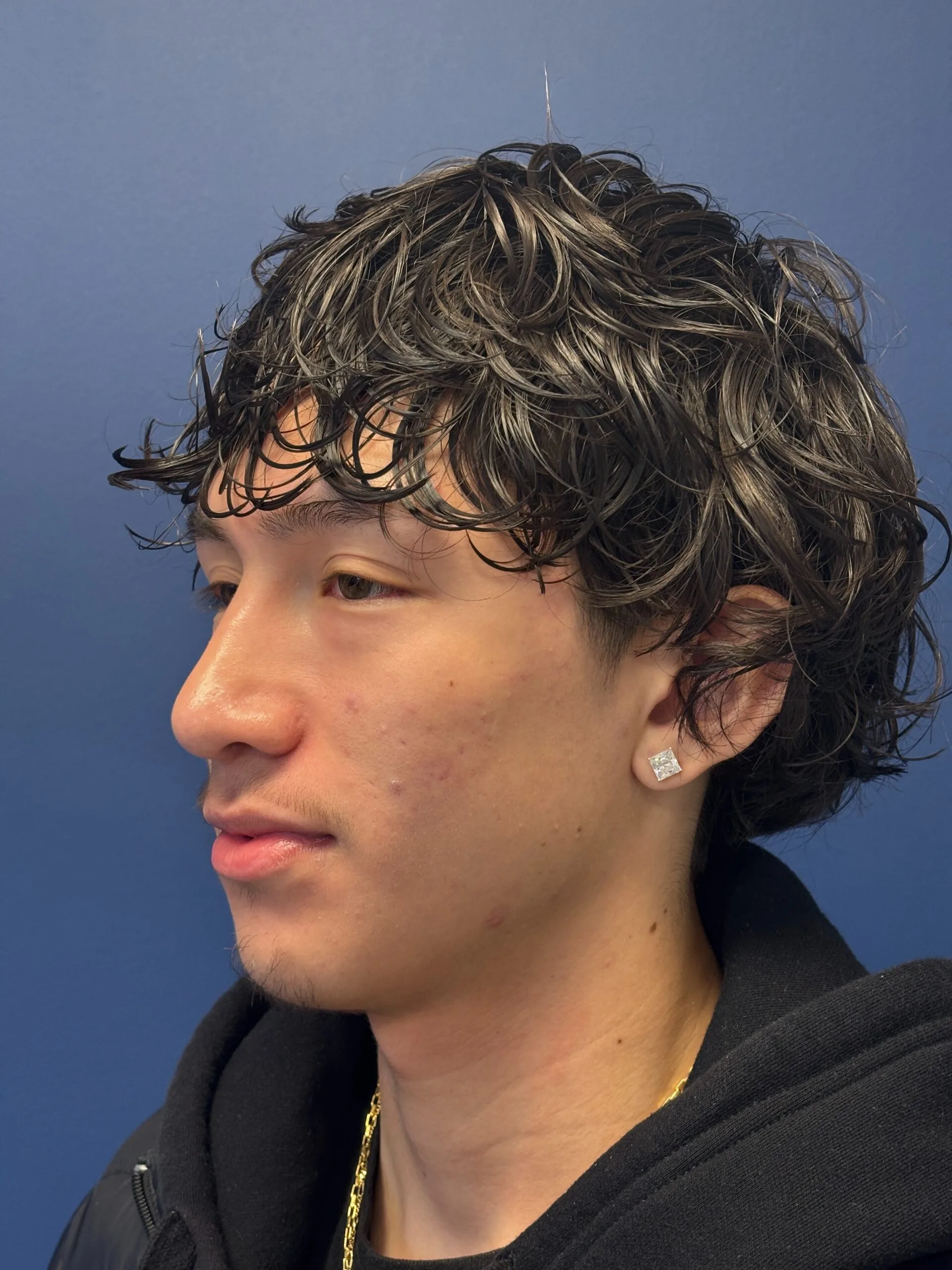 Rhinoplasty-Case--2339 | After Rhinoplasty 5