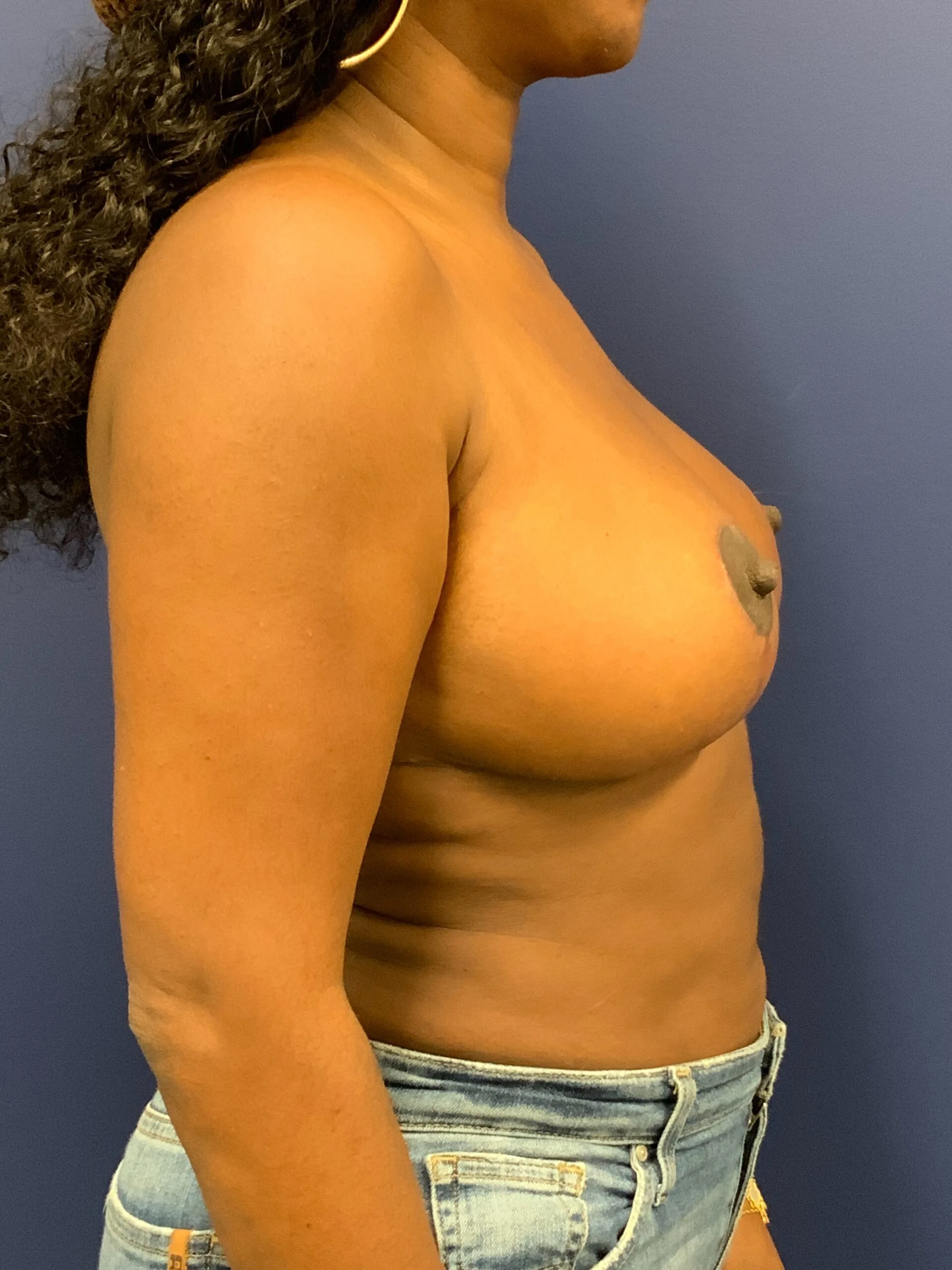 Breast-Reduction-Case--9689 | After Breast Reduction 2
