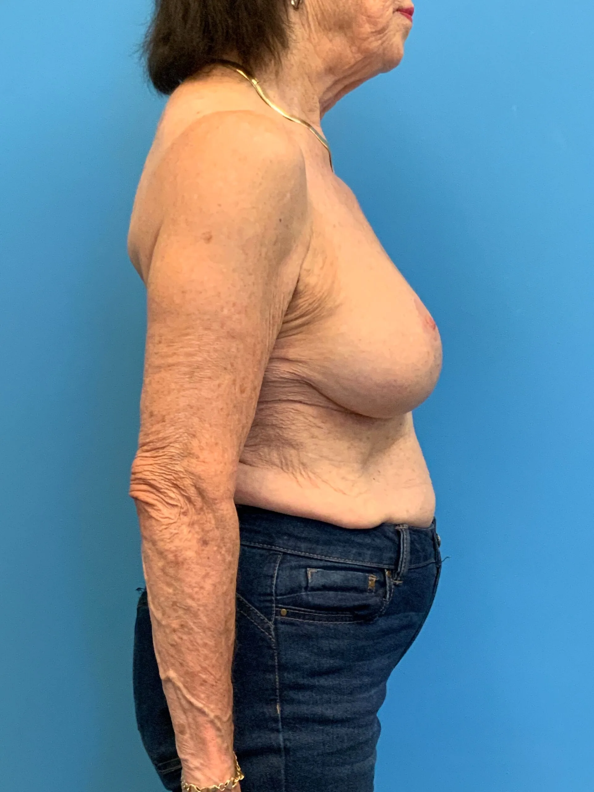 Augmentation-Mastopexy-Case--4504 | After Breast Augmentation With Lift 3