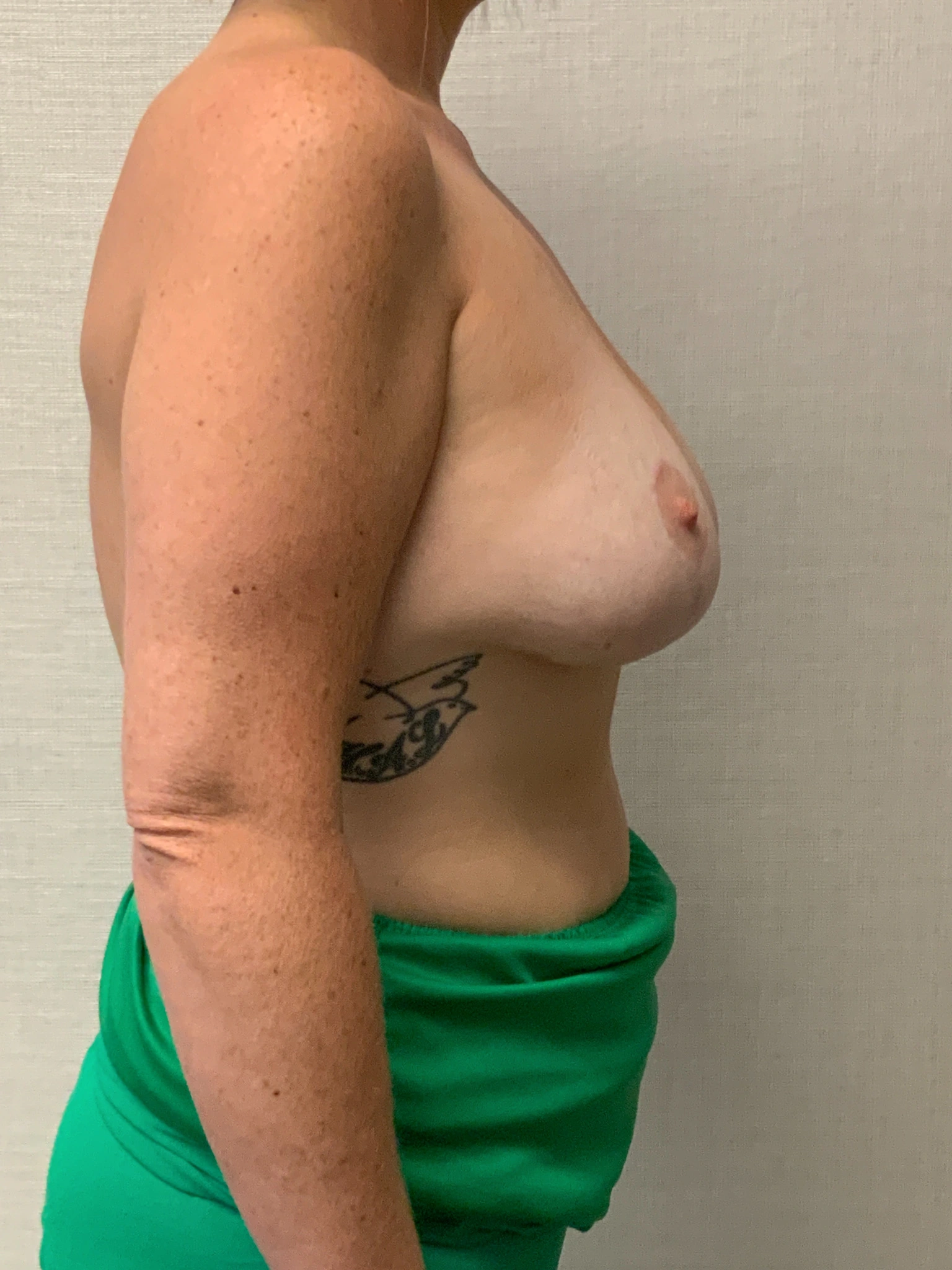 Augmentation-Mastopexy-Case--6355 | After Breast Augmentation With Lift 2