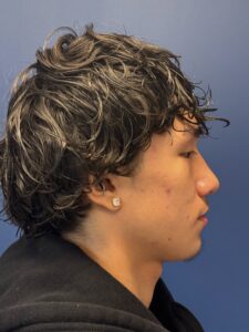 Rhinoplasty-Case--2339 | After Rhinoplasty 2