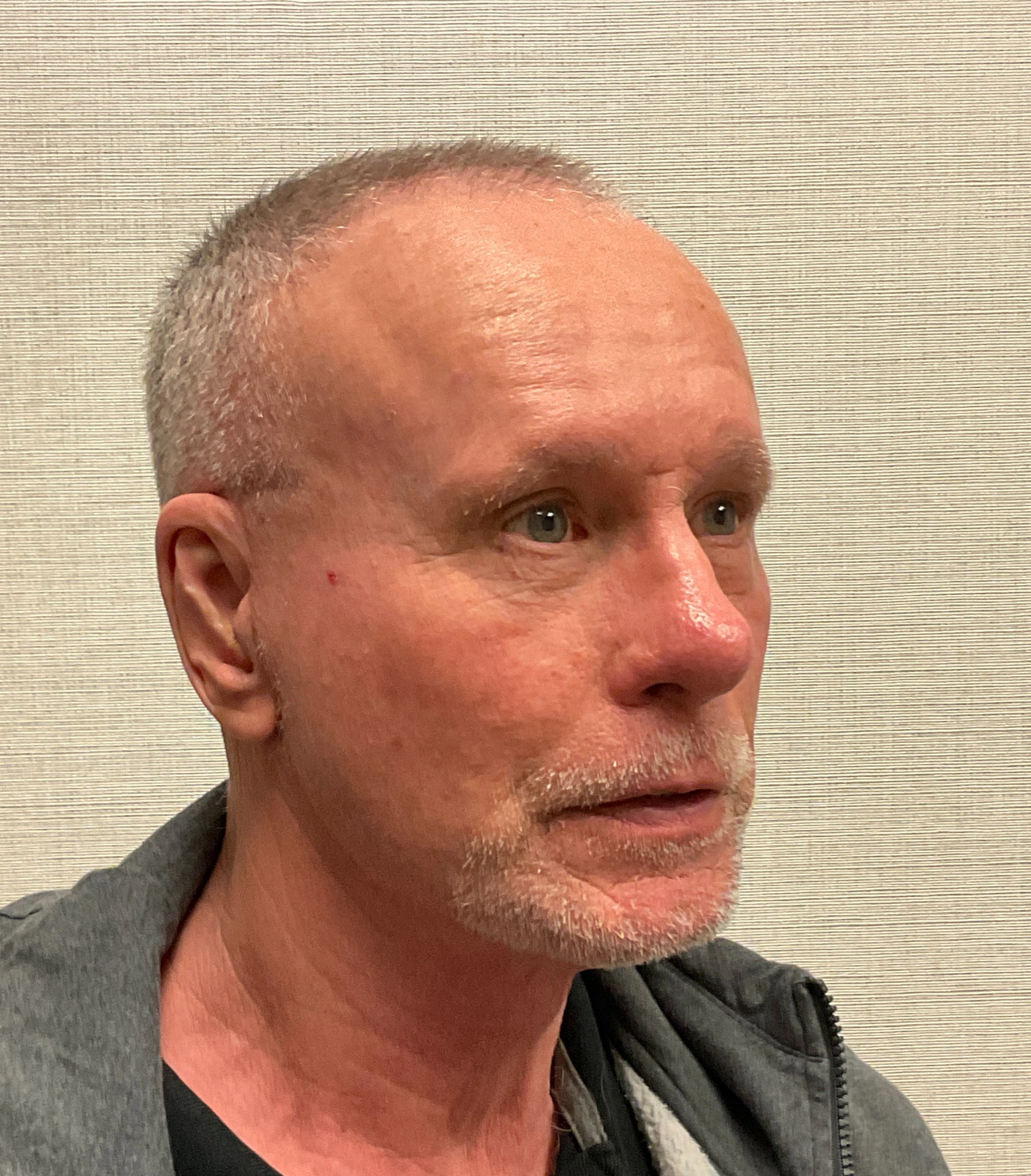 Rhinoplasty-Case--3129 | After Rhinoplasty 5