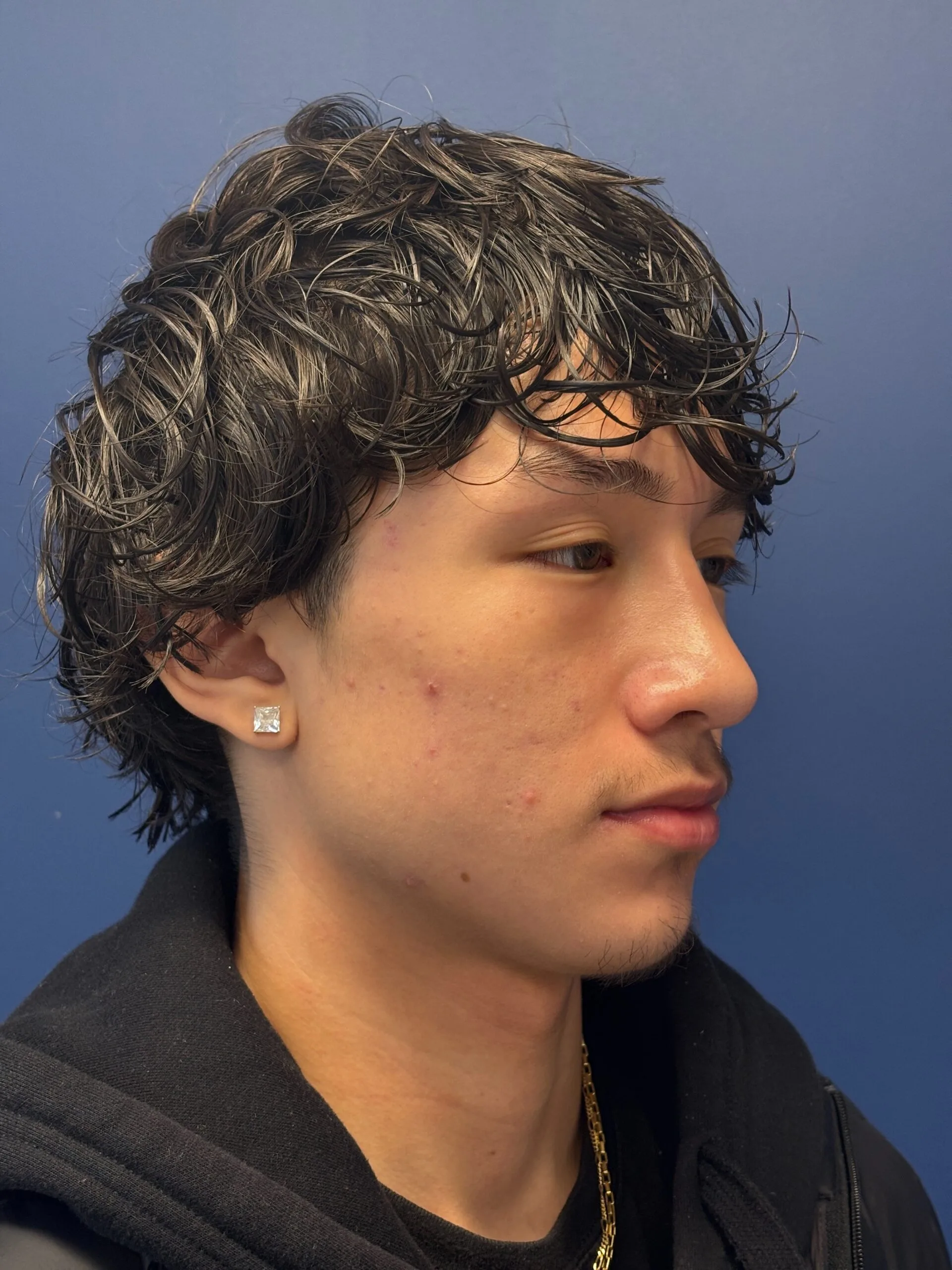 Rhinoplasty-Case--2339 | After Rhinoplasty 4