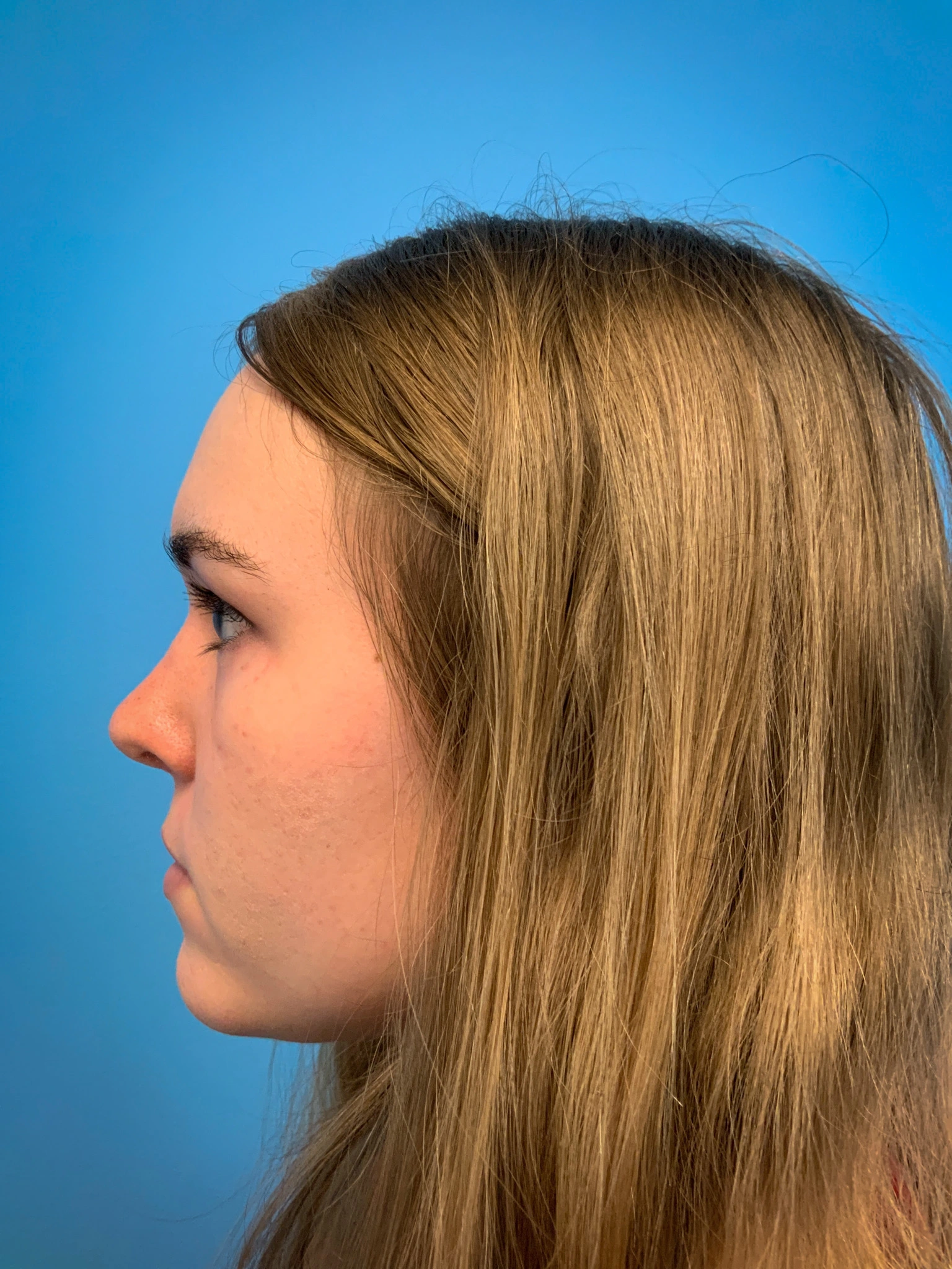Rhinoplasty-Case--6484 | After Rhinoplasty 3