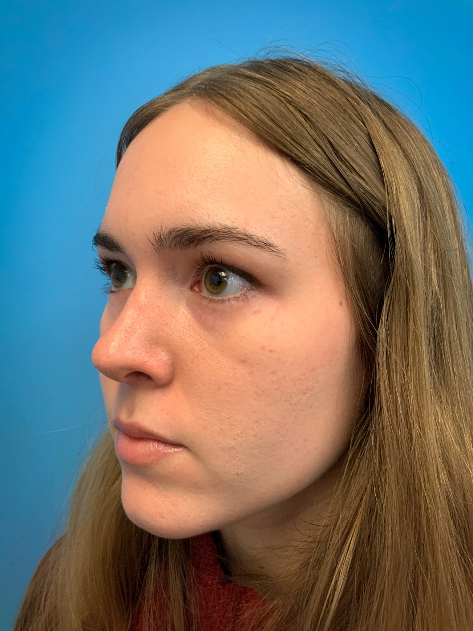 Rhinoplasty-Case--6484 | After Rhinoplasty 5