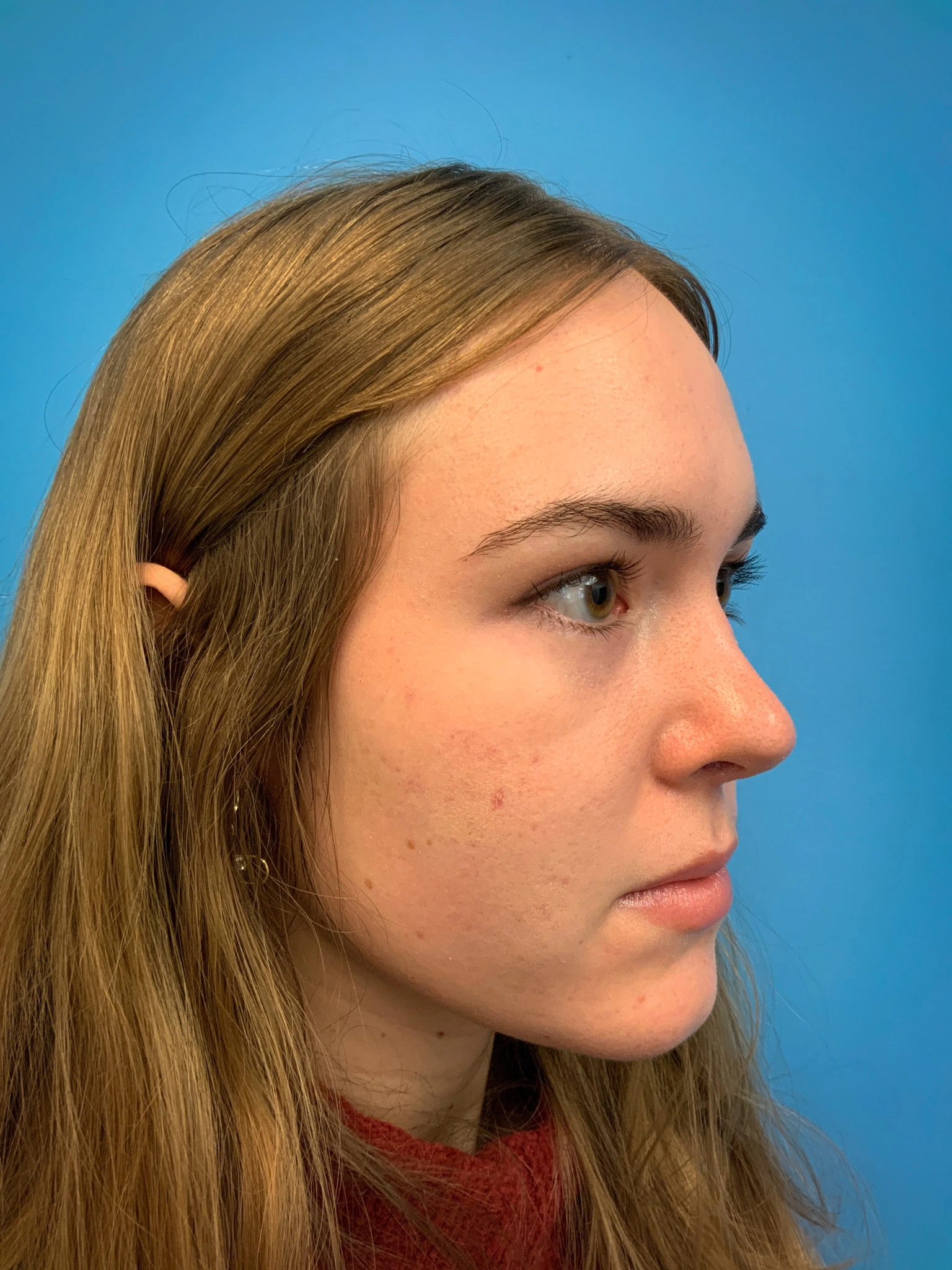 Rhinoplasty-Case--6484 | After Rhinoplasty 4
