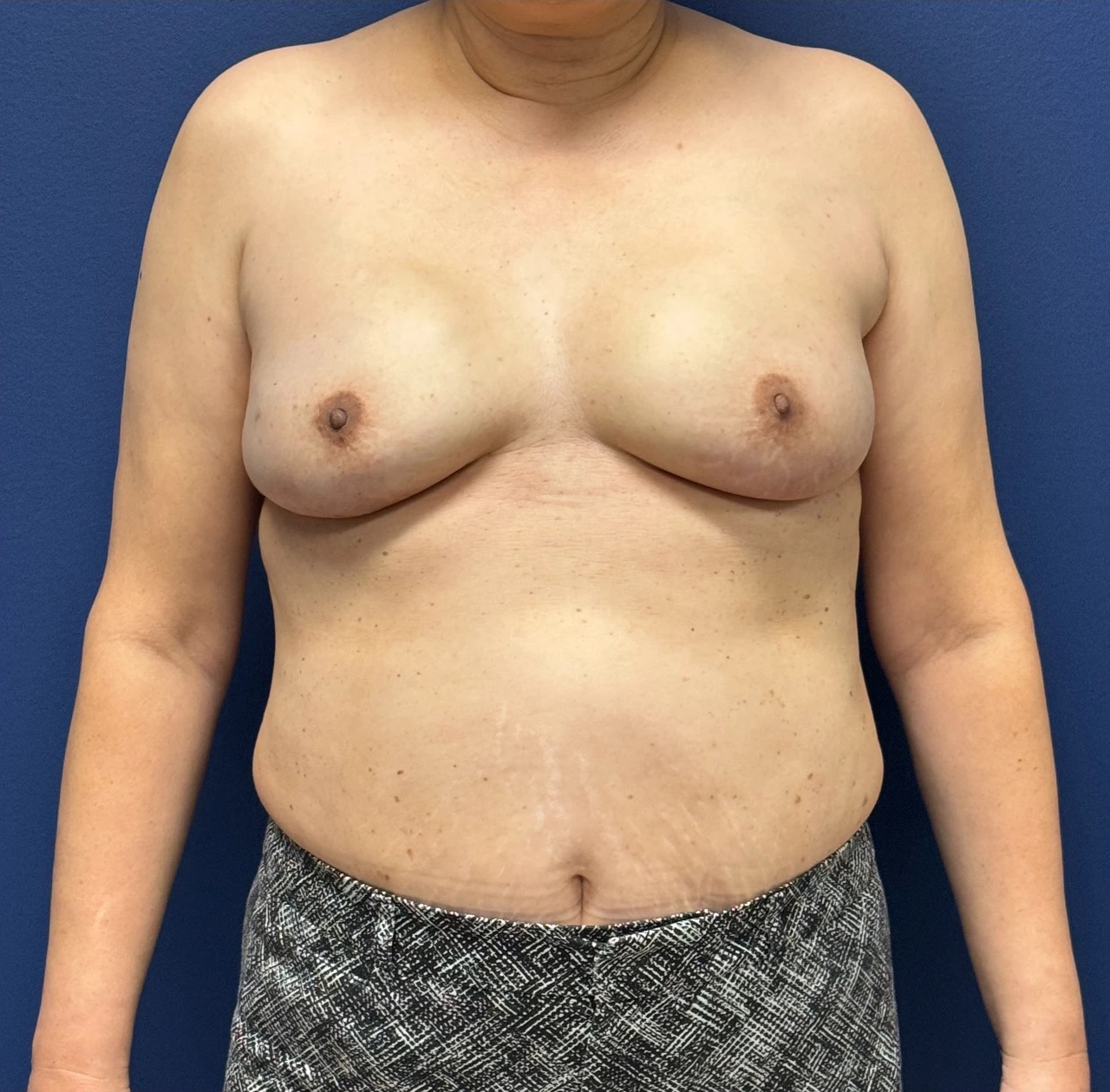 Breast-Reconstruction-Case--28751 | After Breast Reconstruction 1