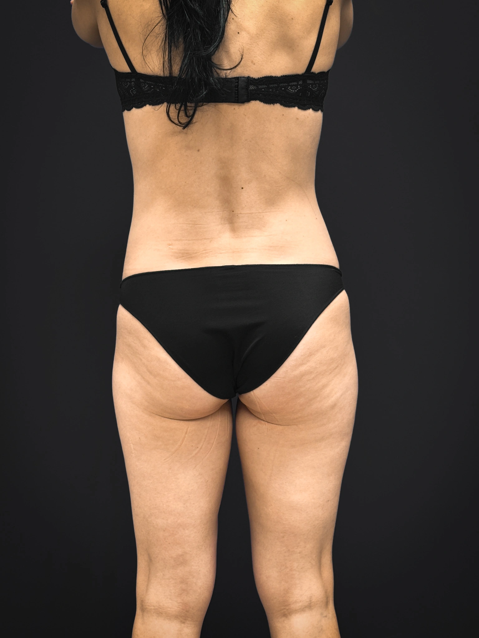 Tummy-Tuck-Case--2729 | After Tummy Tuck 6