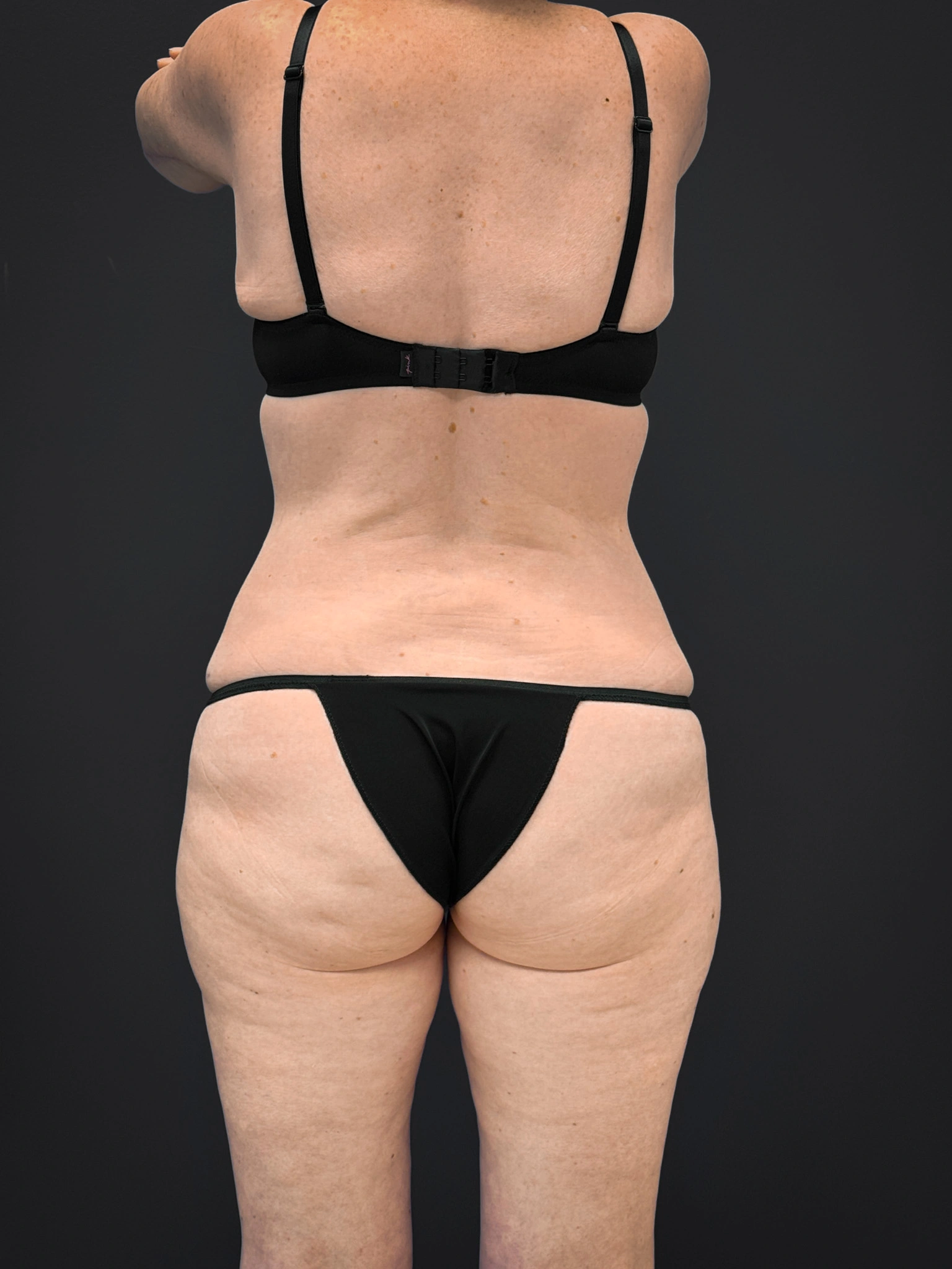 Tummy-Tuck-Case--7170 | After Tummy Tuck 4