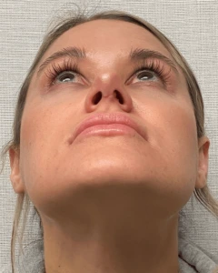 Rhinoplasty-Case--23703 | After Rhinoplasty 2
