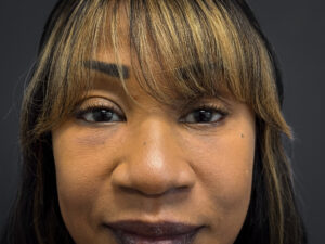 Facelift-Lower-Blepharoplasty-Case--6866 | After Eyelid Surgery 2