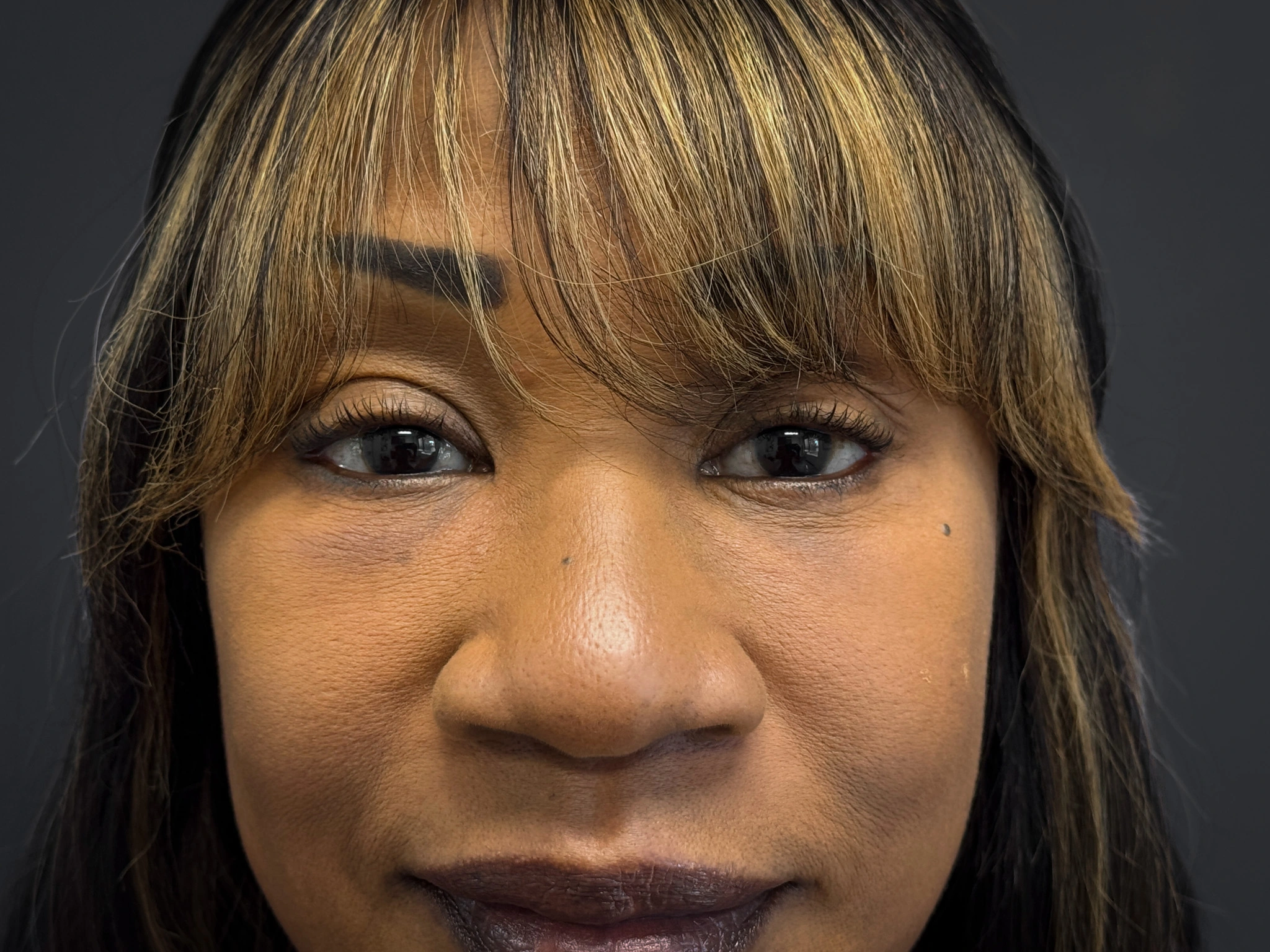 Facelift-Lower-Blepharoplasty-Case--6866 | After Eyelid Surgery 2