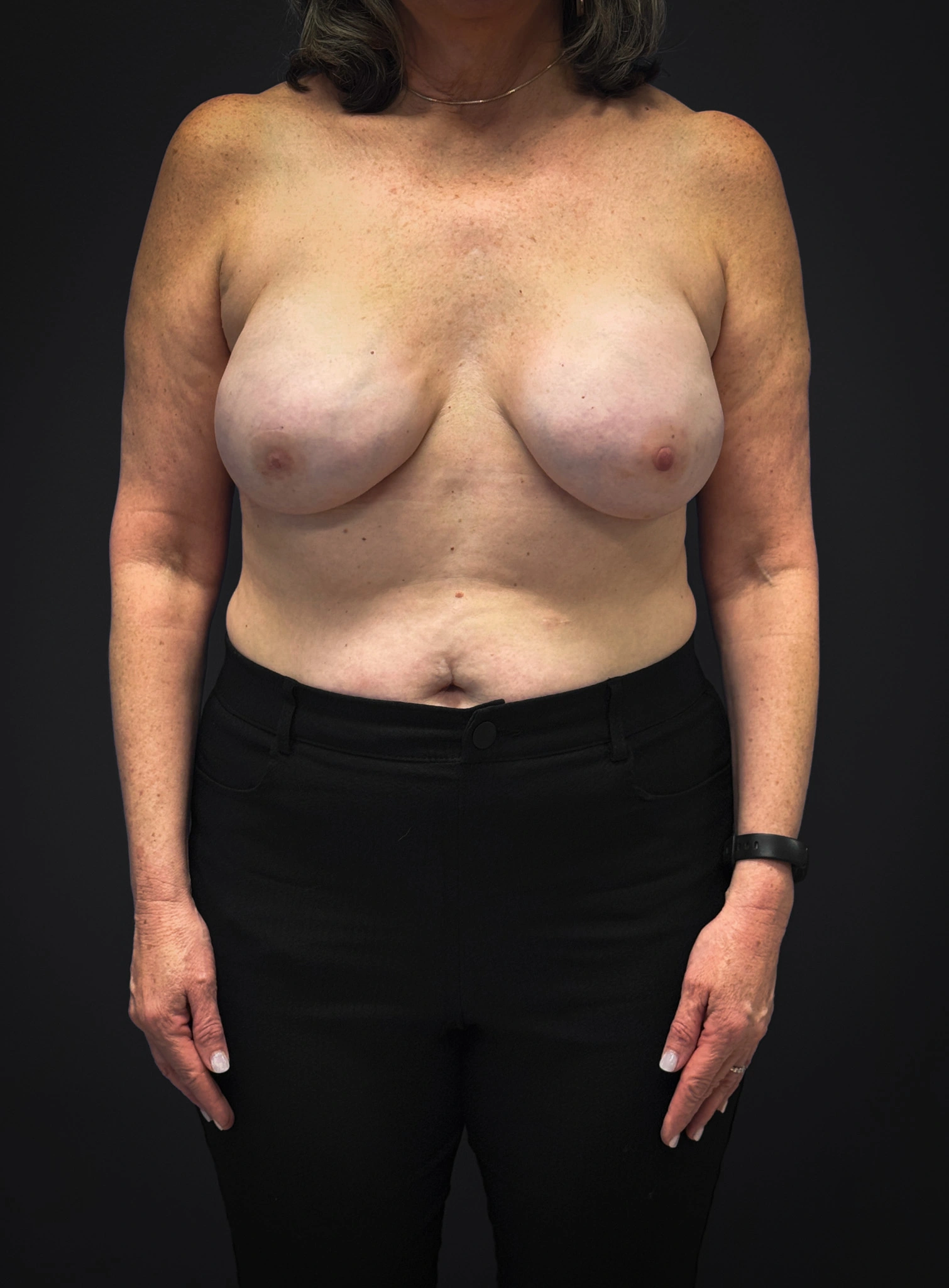 Implant-Reconstruction-Case--2969 | After Breast Reconstruction 1