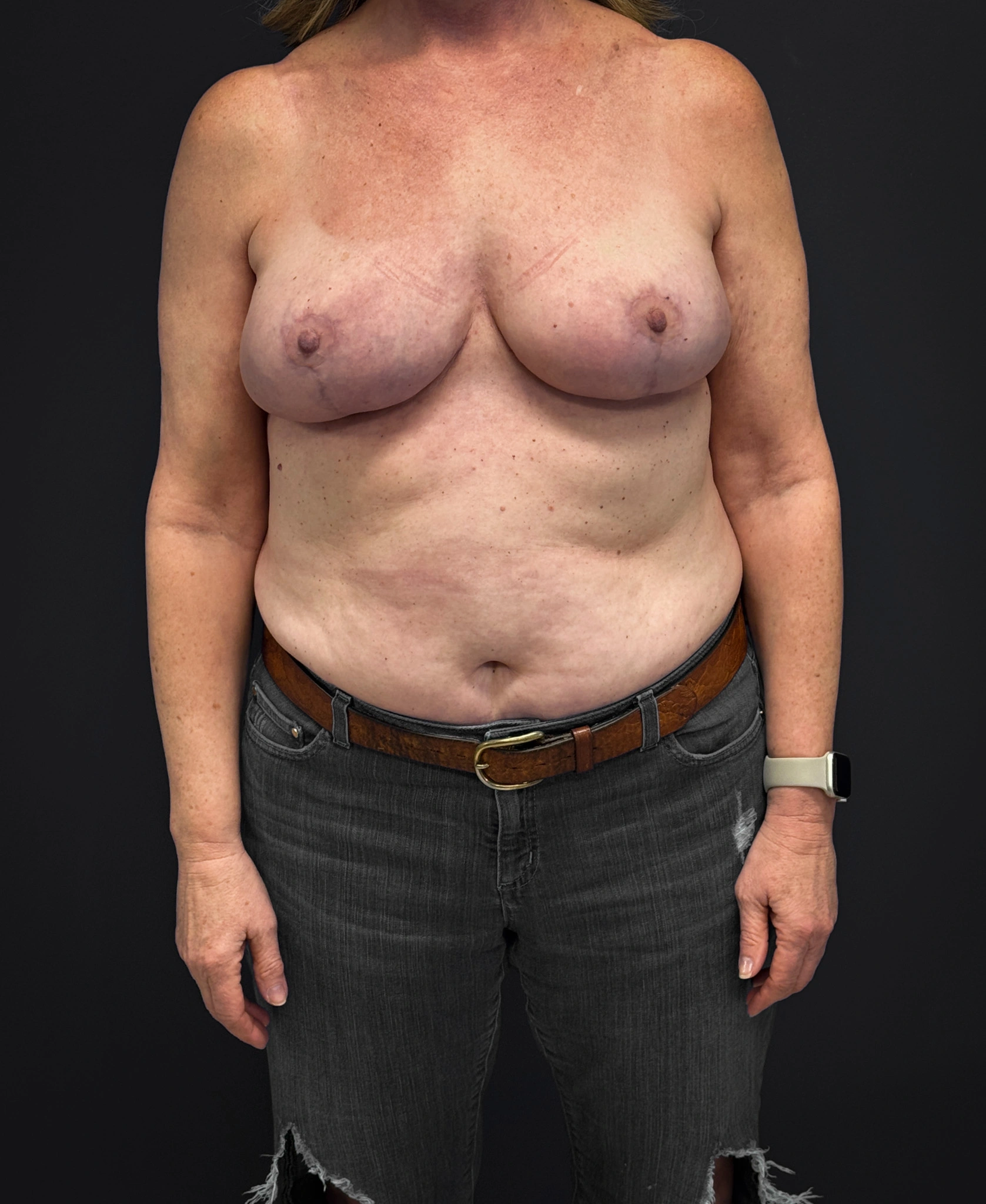 After Mastopexy and Galaflex (front profile)