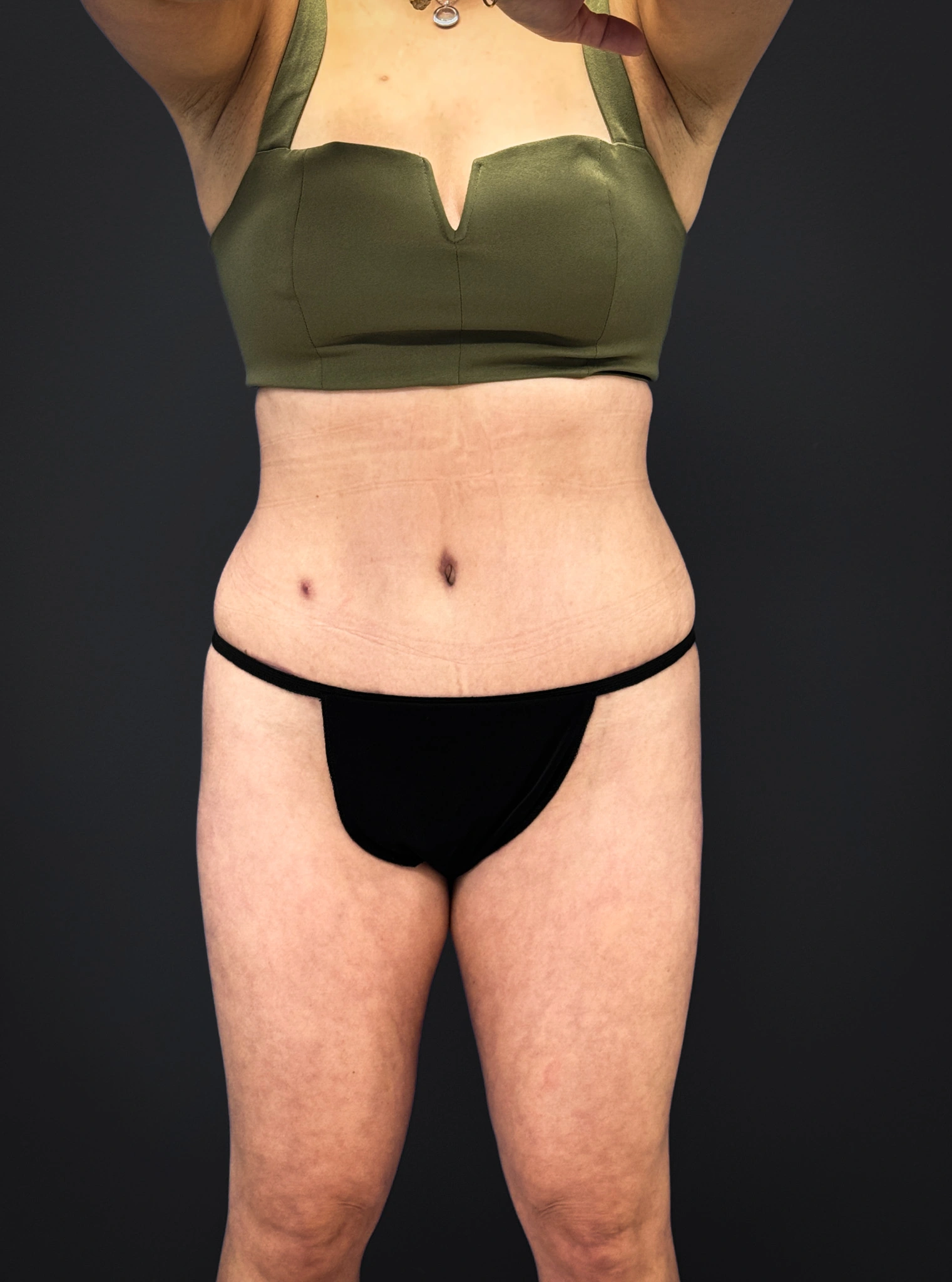 Tummy-Tuck-Case--3757 | After Tummy Tuck 1