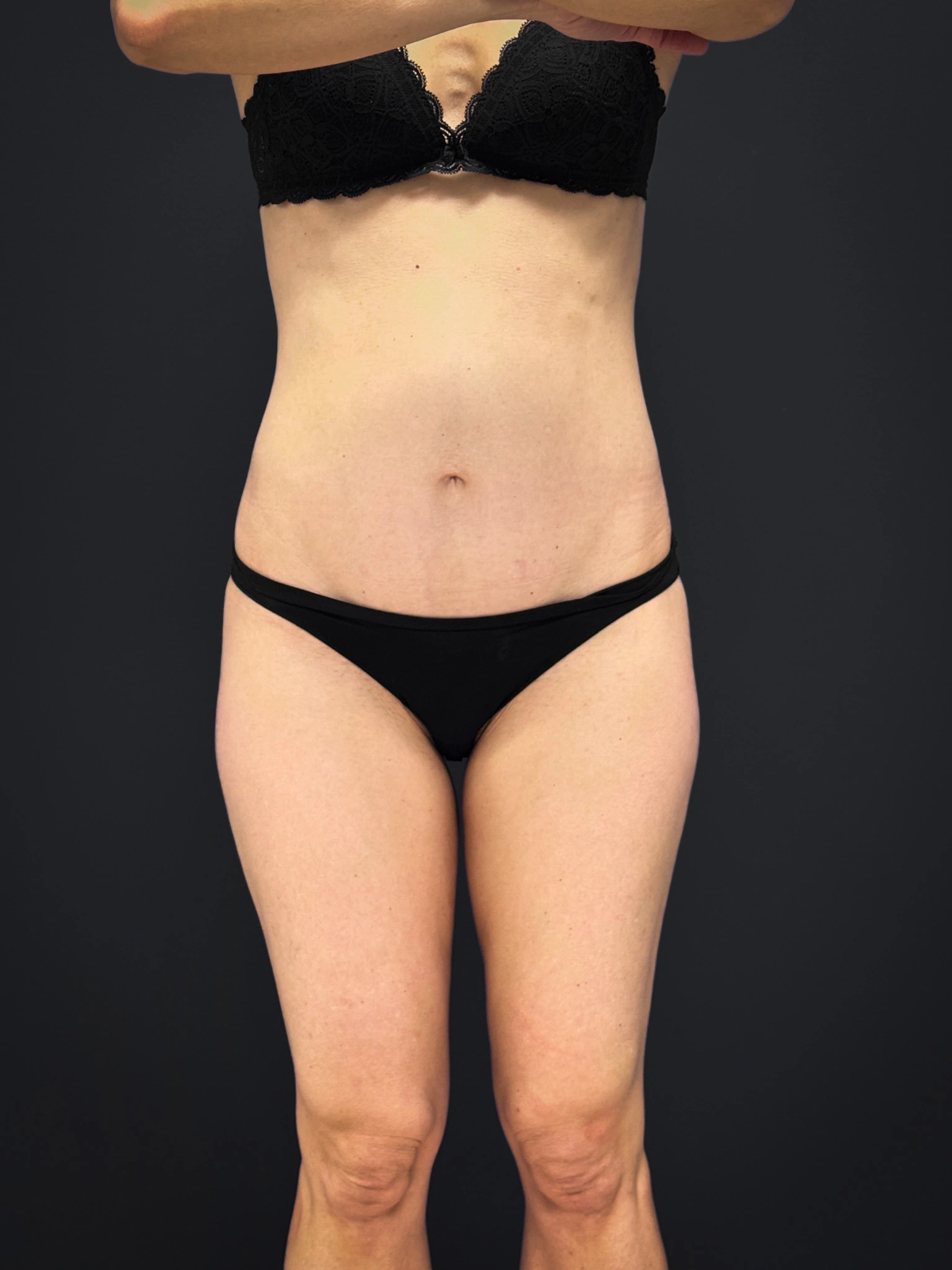 Tummy-Tuck-Case--2729 | After Tummy Tuck 1