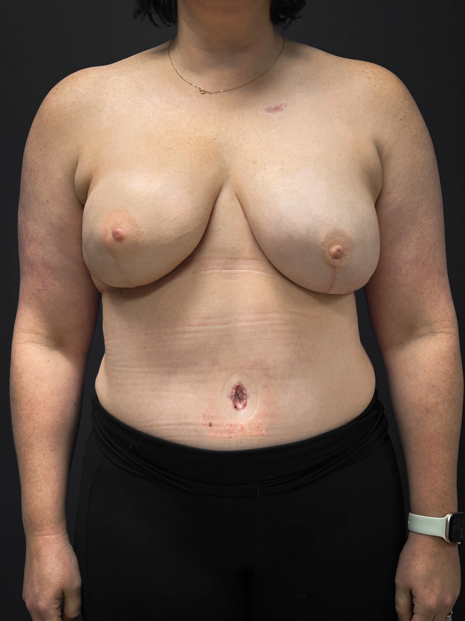 Front profile of patient after undergoing DIEP Flap surgery