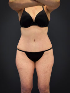 Tummy-Tuck-Case--7170 | After Tummy Tuck 1