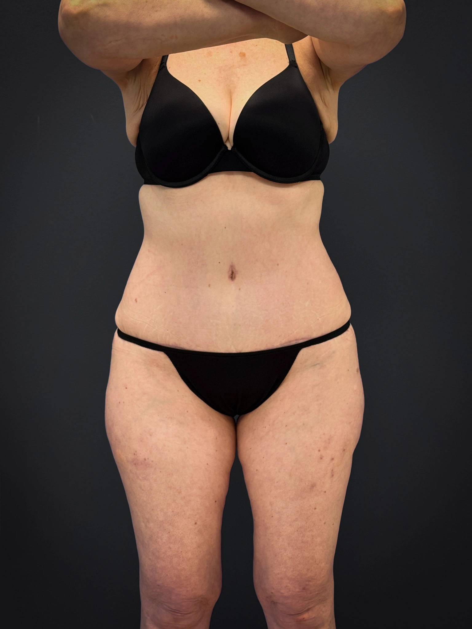 Tummy-Tuck-Case--7170 | After Tummy Tuck 1