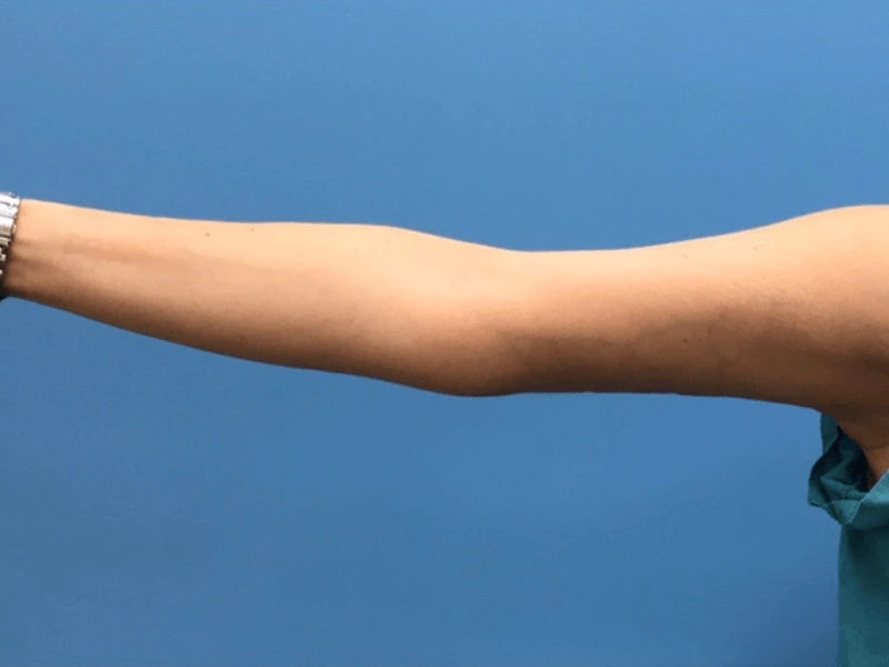 Brachioplasty-Case--276 | After Arm Lift 3