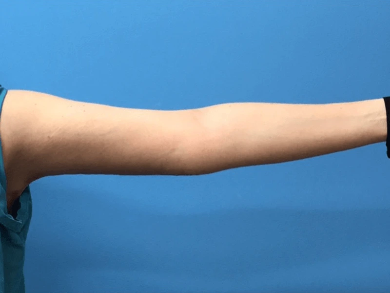 Brachioplasty-Case--276 | After Arm Lift 4