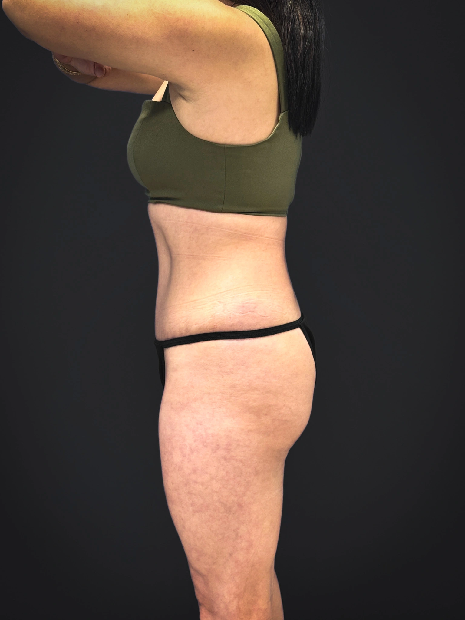 Tummy-Tuck-Case--3757 | After Tummy Tuck 5