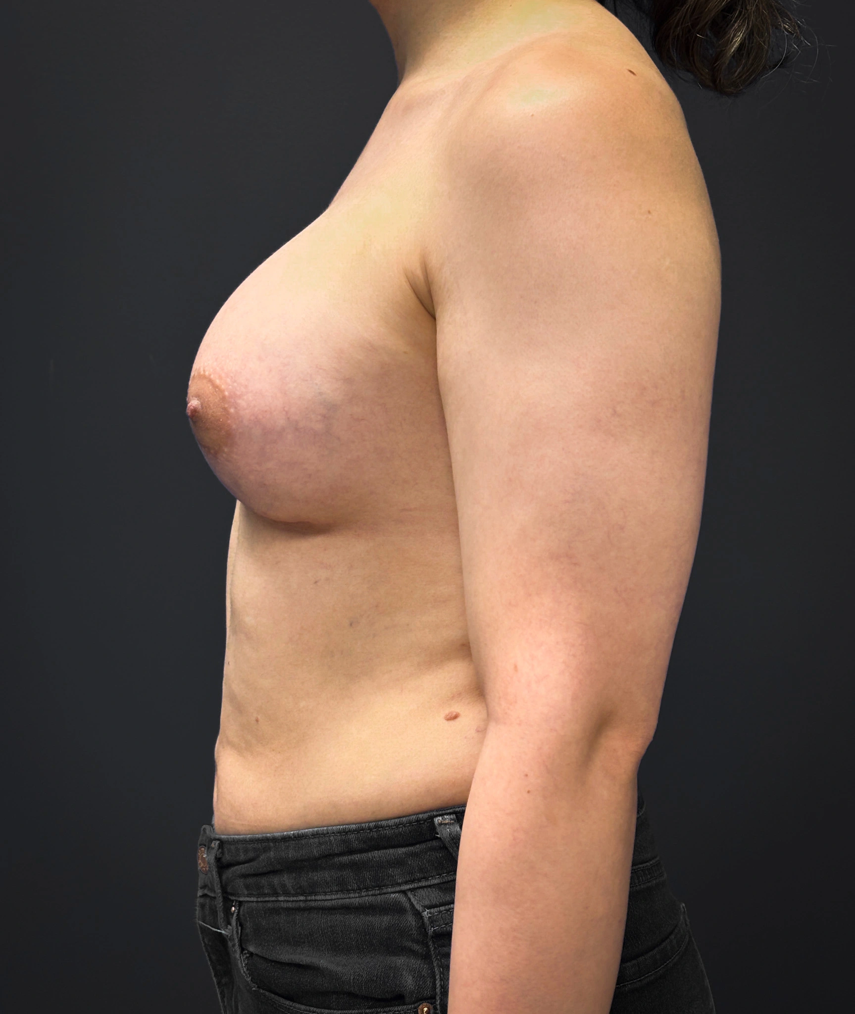 Left profile of patient after undergoing breast augmentation surgery