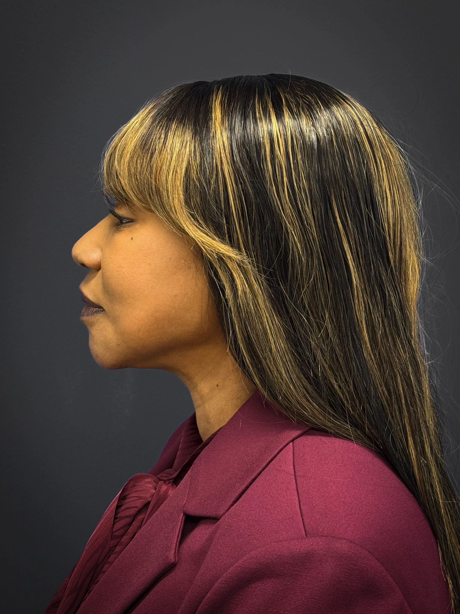 Facelift-Lower-Blepharoplasty-Case--6866 | After Eyelid Surgery 3