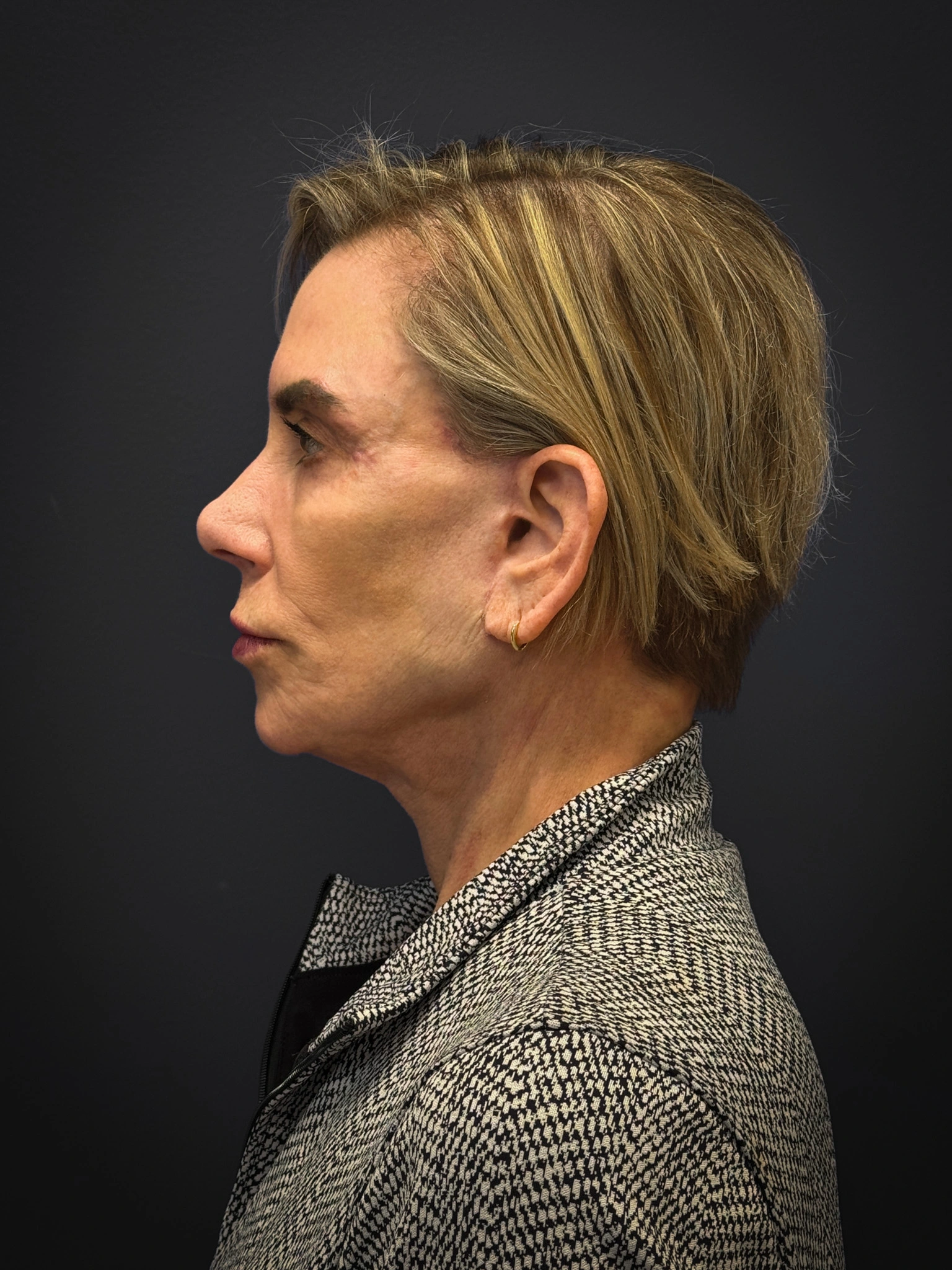 Facelift-Case--4219 | After Facelift 4