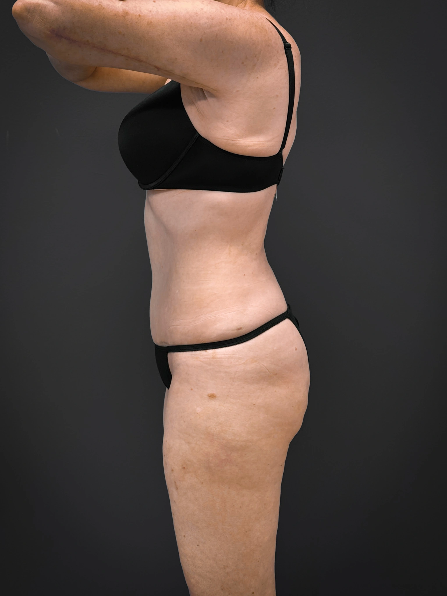 Tummy-Tuck-Case--7170 | After Tummy Tuck 3