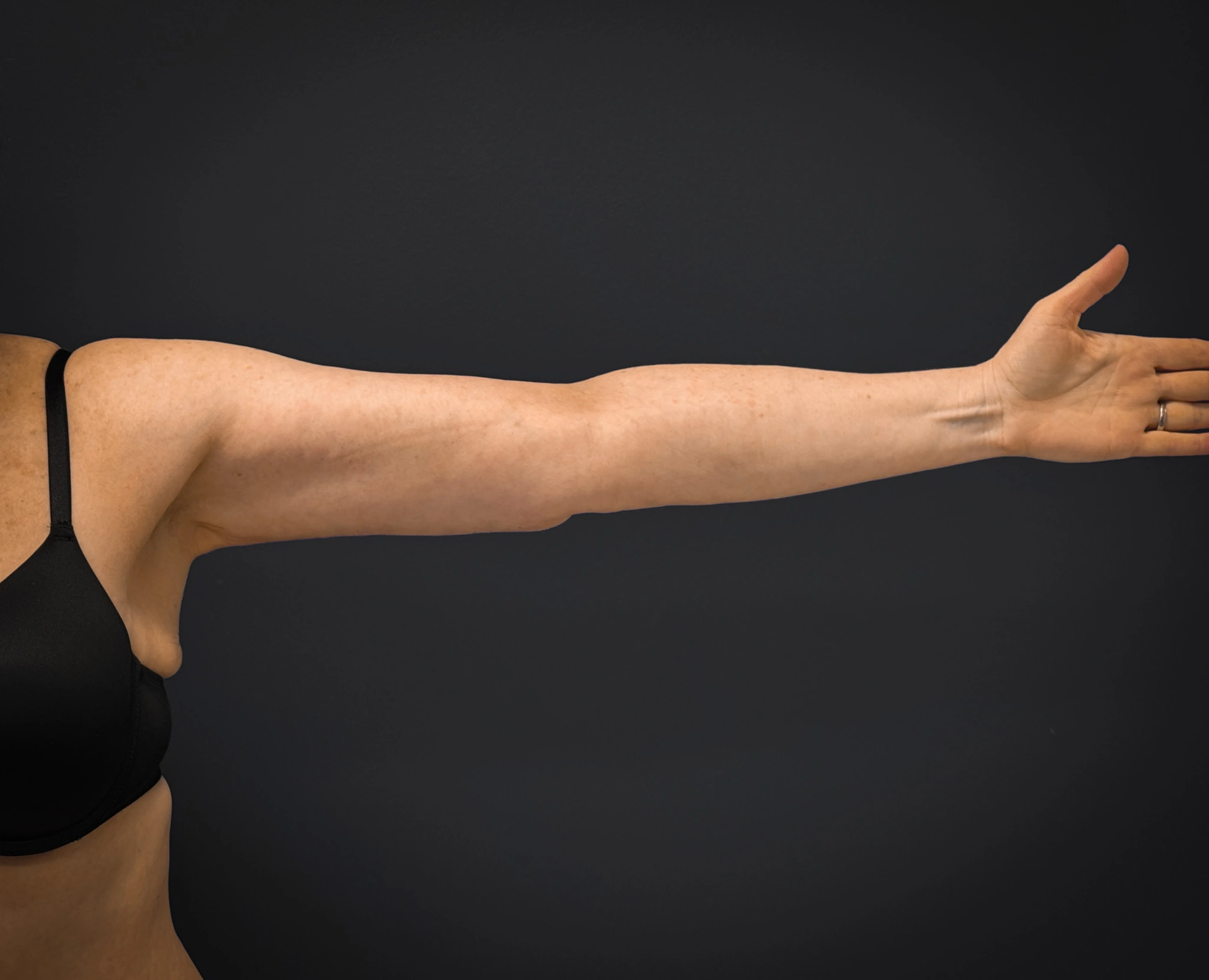 Brachioplasty-Case--3119 | After Arm Lift 2