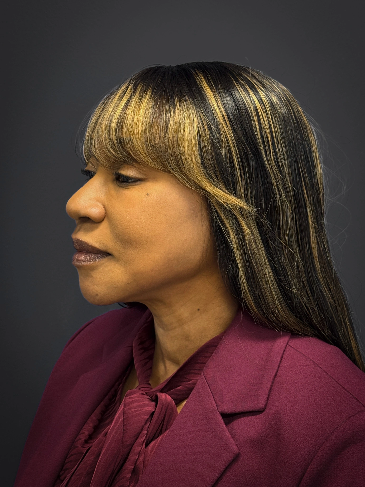 Facelift-Lower-Blepharoplasty-Case--6866 | After Eyelid Surgery 5