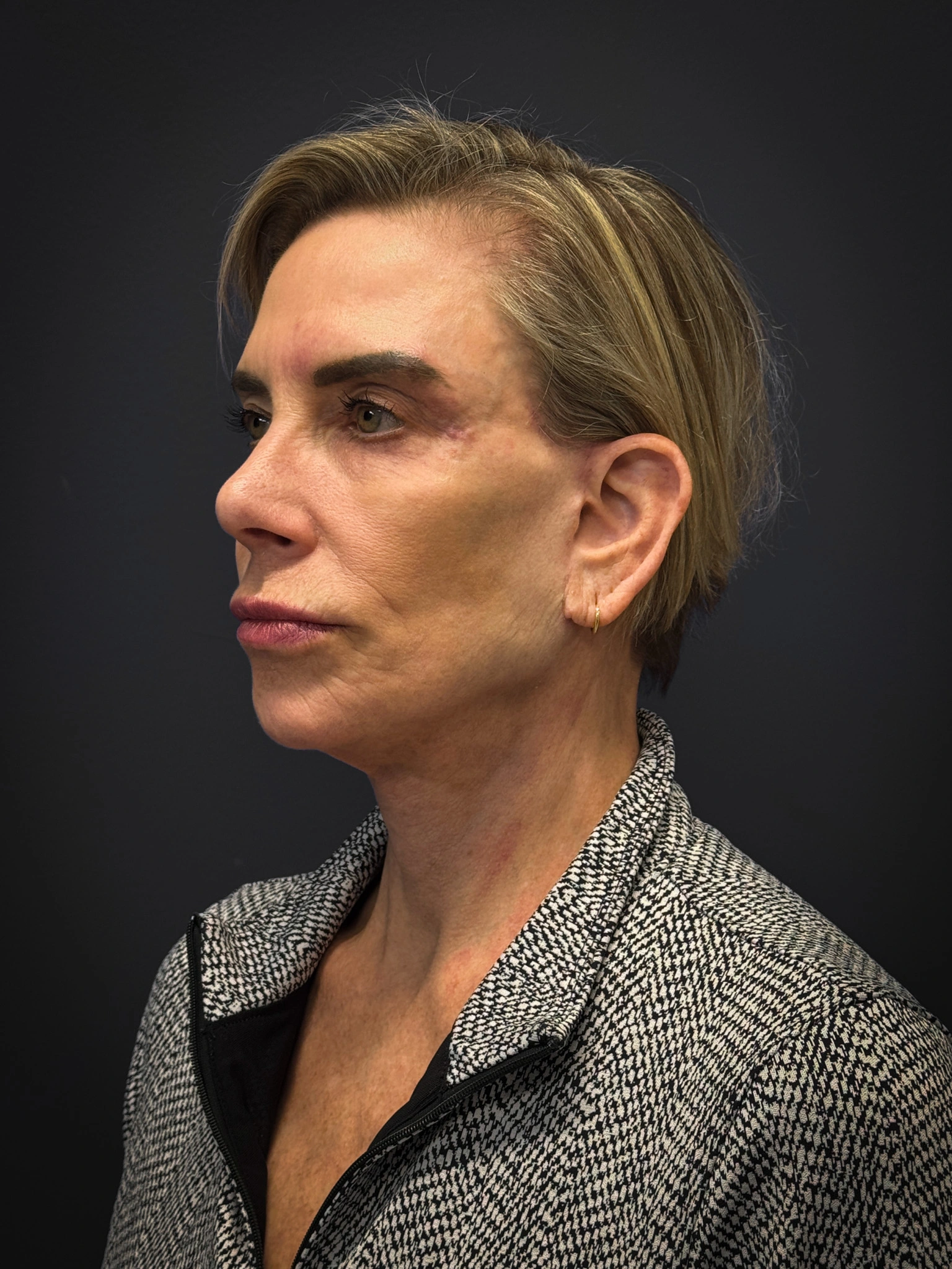 Facelift-Case--4219 | After Facelift 5