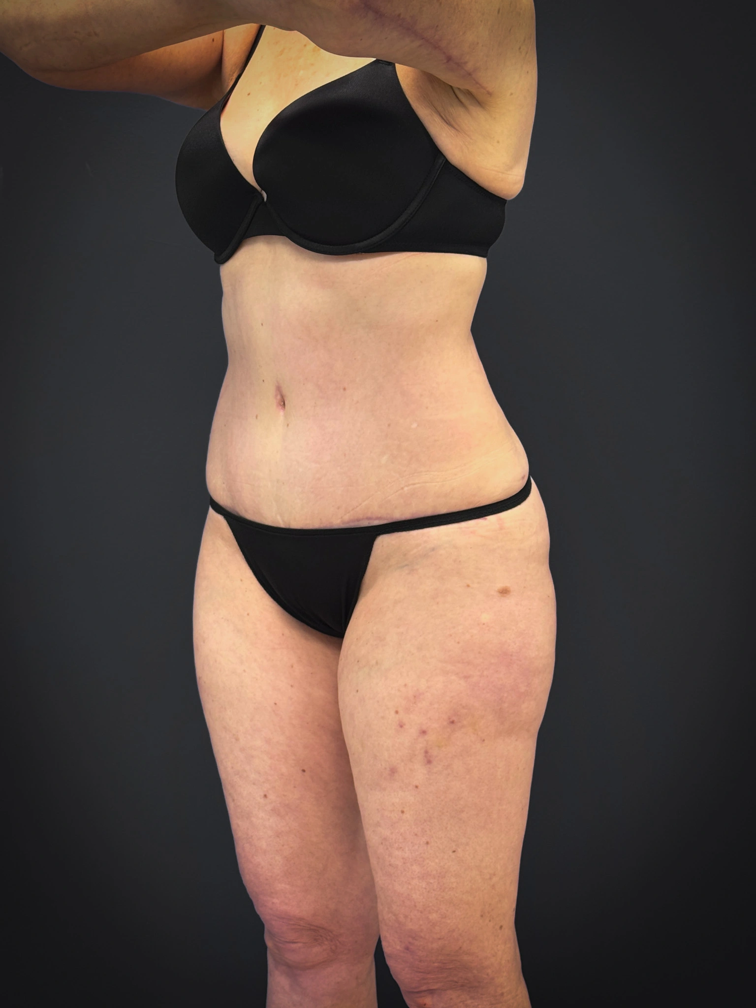 Tummy-Tuck-Case--7170 | After Tummy Tuck 2