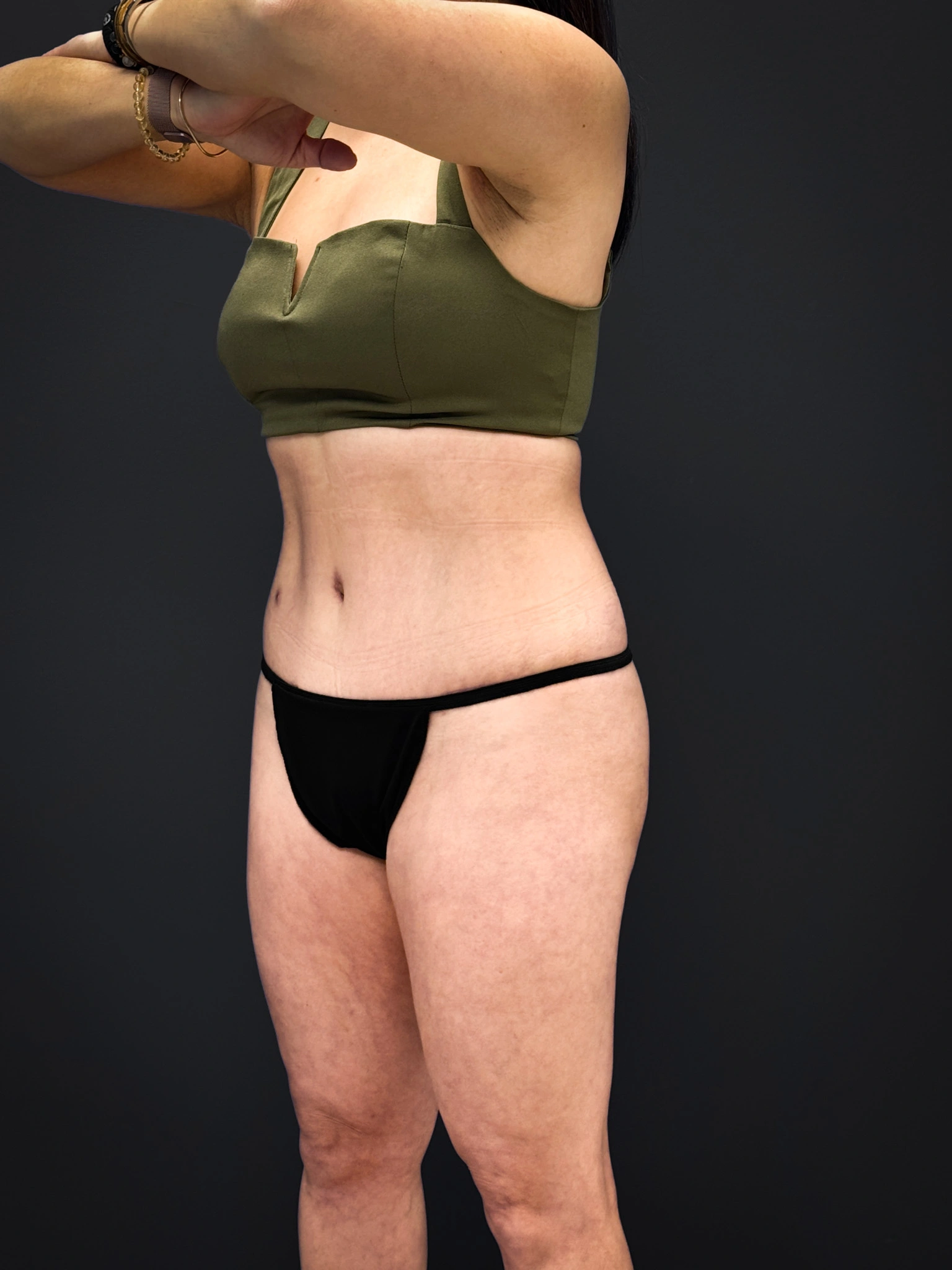 Tummy-Tuck-Case--3757 | After Tummy Tuck 4